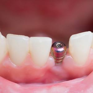 A placed dental implant without its final restoration