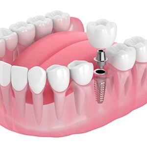 Illustration of a single dental implant