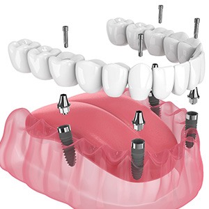 Illustration of an implant denture