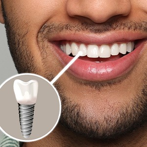 A photo highlighting a bearded man’s complete dental implant