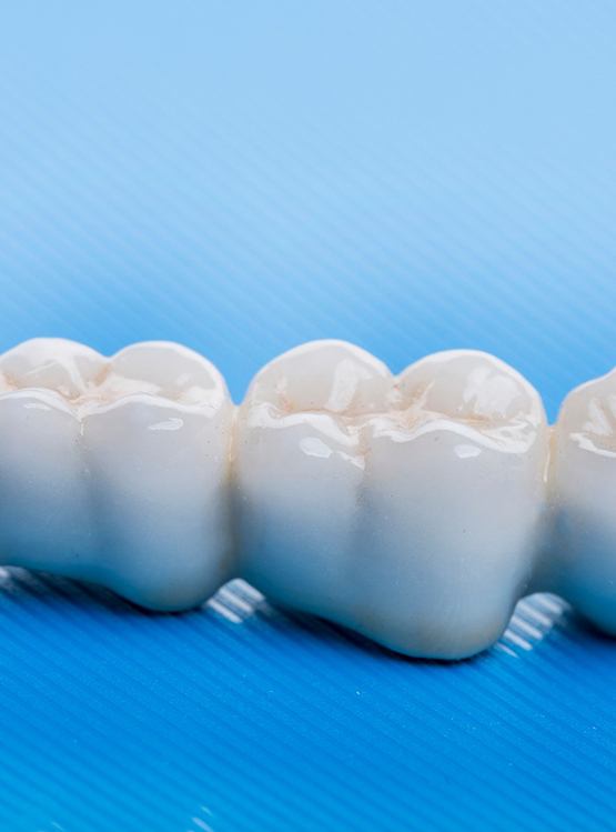 A dental bridge