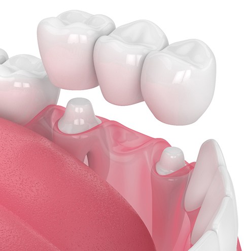 A CGI of a dental bridge