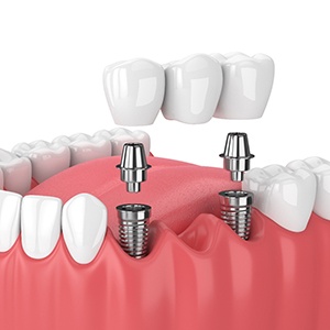 A CGI of a dental implant bridge