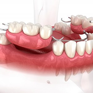 Illustration of partial dentures