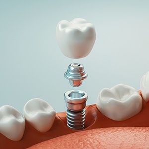 A 3D rendering of a completed dental implant’s parts
