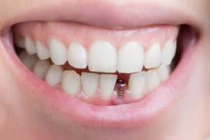 Close up of person smiling to reveal a titanium dental implant