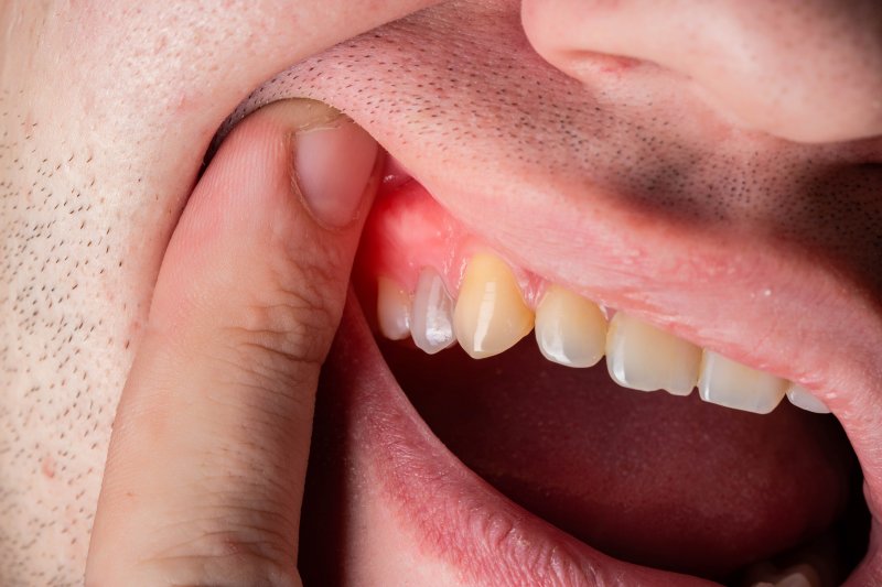 A man revealing his red and swollen gums
